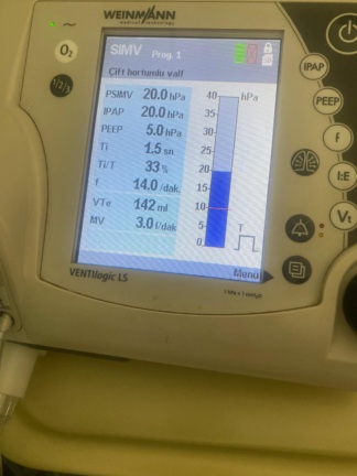 Secondhand Weinmann Ventilogic LS Home Mechanical Ventilator