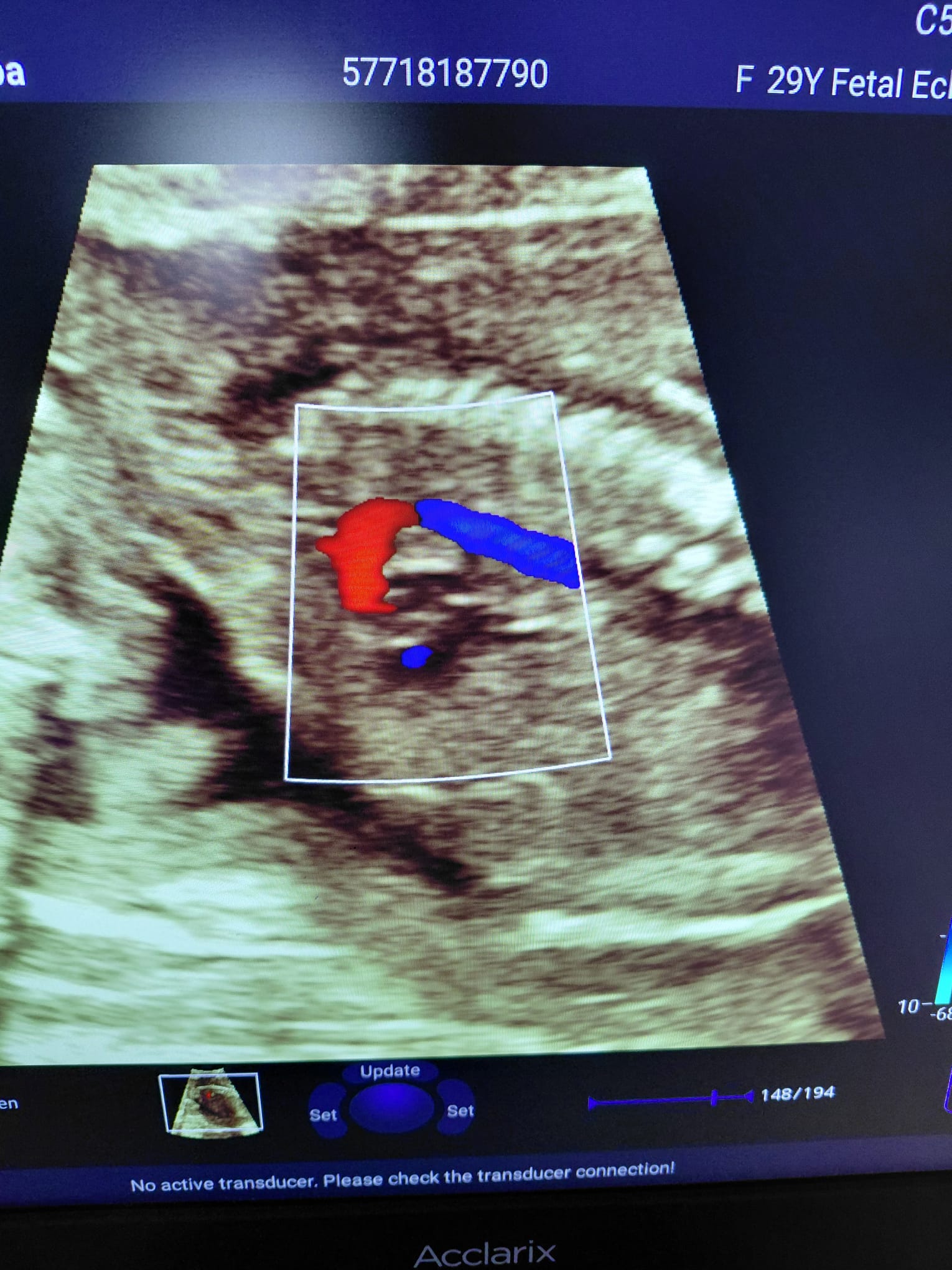 Secondhand Edan Acclarix LX3 Echocardiography Machine - Image 5