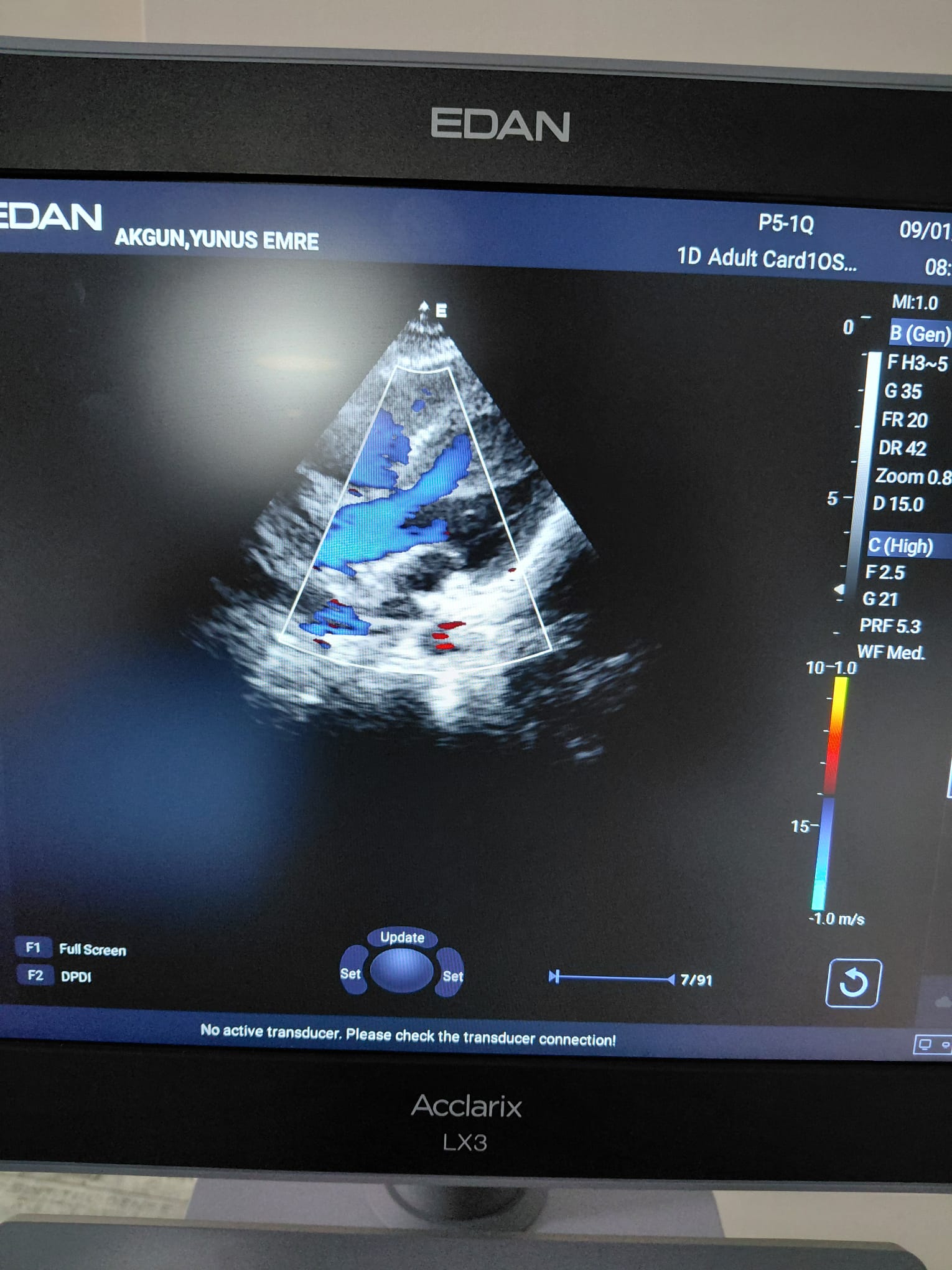Secondhand Edan Acclarix LX3 Echocardiography Machine - Image 4